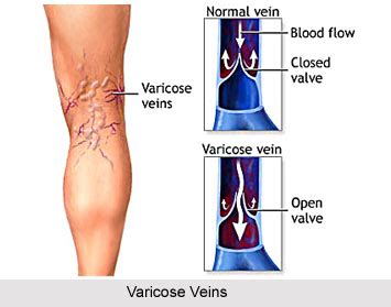 We did not find results for: Yoga For Varicose Veins