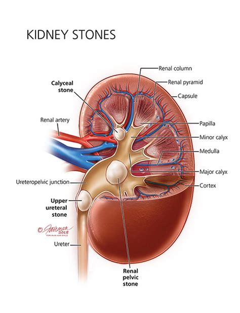 The stones develop in the kidney but can move into the bladder. Kidney Stones: Causes, Diagnosis & Treatment | Atlantic ...