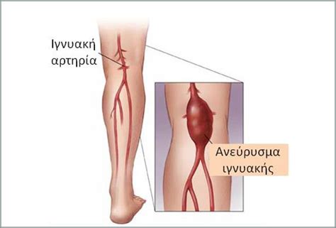 Νέες εικόνες από τα άγρια επεισόδια στη νέα σμύρνη. Περιφερικά Ανευρύσματα: Αίτια, Συμπτώματα & Θεραπεία