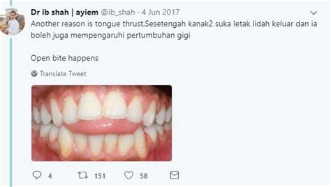 Gigi jongang menimbulkan masalah seperti sukar penutupan mulut, pengunyahan dan bercakap malah gigi juga lebih mudah terdedah kepada kecederaan, terutamanya semasa bersukan. Doktor Ini Kongsi Risiko Gigi Anak Jongang Kalau Ada ...