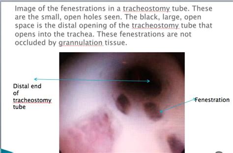 In this video greg shares a brief sample of his morning respiratory routine in the. Dysphagia in tracheostomy and ventilator-dependent ...