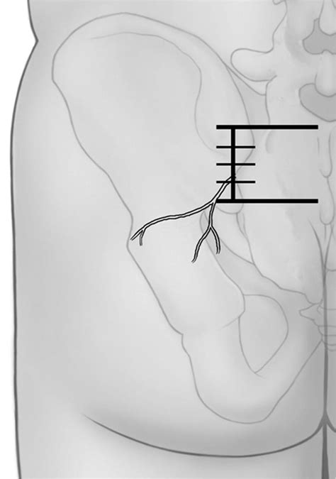 Because this technique requires few injections to reach adequate anesthesia, a smaller volume of anesthetic is needed. Anatomical illustration of the middle cluneal nerve. The ...