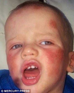 Toddler whose eczema was so severe no longer scratches ...