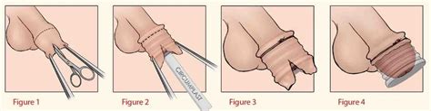 To care for an adult's circumcision, wait for at least 48 hours after the procedure to have a bath or shower, as you need to avoid the wound getting wet. Baby and Newborn Circumcision — London Circumcision Clinic ...