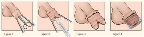 Learn more about how the procedure works, possible complications, and treatment of the circumcised penis. Baby and Newborn Circumcision — London Circumcision Clinic ...