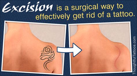 The only safe and effective practice to remove tattoos is to see an expert with the latest technology laser.cost of tattoo removal typical cost will range from $50 to $500. Tattoo Removal Cost - Thoughtful Tattoos