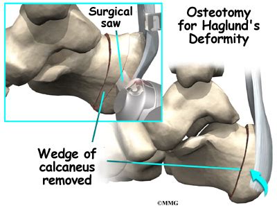 It affects the bone and the soft tissues. Haglund's Deformity of the Foot | Orthogate