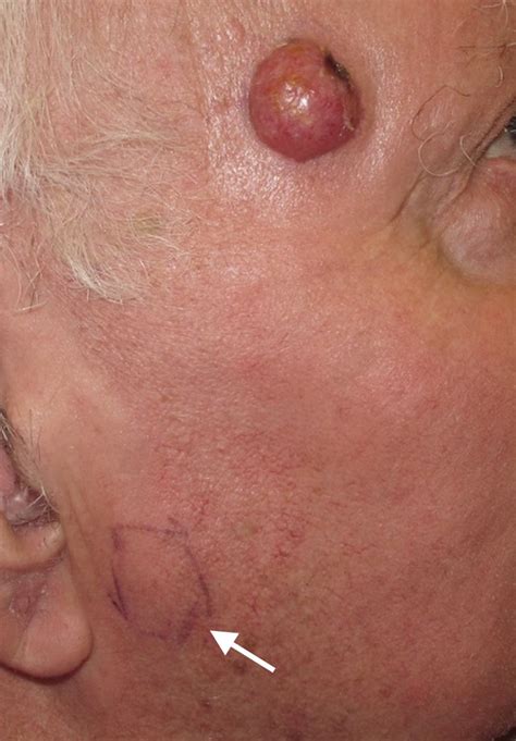 Merkel cell carcinoma is a rare neuroendocrine carcinoma of the skin mostly induced by merkel cell polyomavirus integration. Merkel Cell Carcinoma Pictures - Diagnosis and Management ...