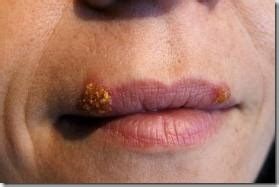 A herpes tzanck smear shows enlarged nuclei that occupy most of the cell. small herpes on lips - pictures, photos