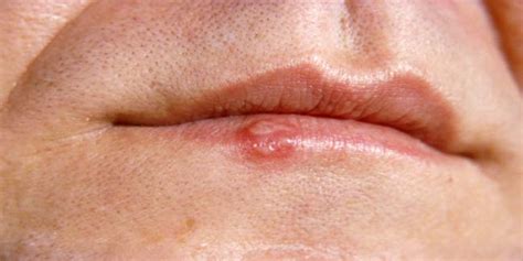 Cold sores are small ulcers that erupt around the lips and nostrils. How to Prevent a Cold Sore When You Feel it coming
