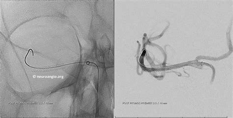 Many cardiologists say the warning is not warranted, but radiologists obviously, sick patients may have adverse outcomes that have little to do with having had an mri, so the question potentially becomes, are there data to. Archives_Stroke_M1_Reocclusion_Stenting | neuroangio.org
