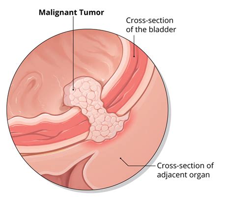 The most common type urinary bladder cancer seen in cats is rooted from a tumor called transitional cell carcinoma (tcc). Types of Bladder Cancer | Roswell Park Comprehensive ...