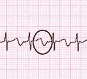 Chest Pain and Palpitations in a Young Woman | Consultant360
