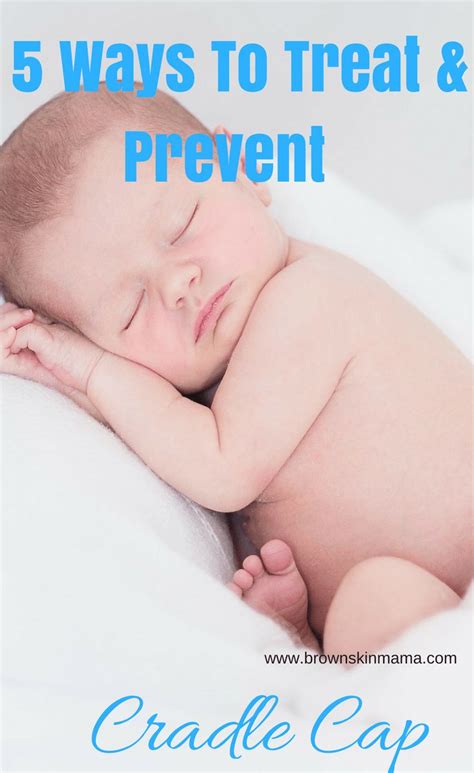 Maybe you would like to learn more about one of these? How to Prevent Cradle Cap In Babies | Cradle cap, Newborn ...