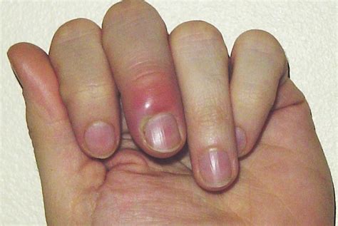 When viewed in the beginning of. Worst Nail Infections: Paronychia - Medical Videos