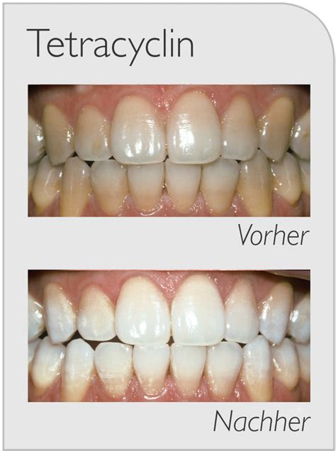 I have natural dark hair and on my ends is a few tones lighter from a previous bleaching that i did 2 years ago. ZOOM Bleaching - WHITE SMYLE Dental ...