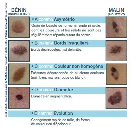 Un grain de beauté est une tache ronde et foncée causée par un développement anarchique des mélanocytes. Mélanome : 5 signes pour le reconnaître - Vulgaris Médical
