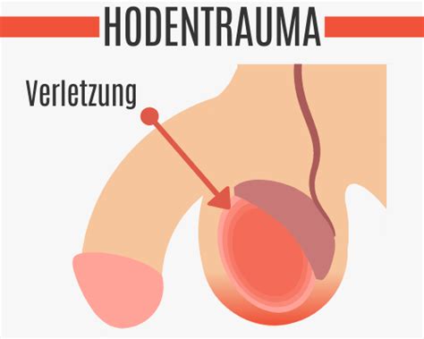 Ein kompletter leistenbruch bei der frau äußert sich meistens durch eine vorwölbung oder verdickung im unterbauch, die schmerzhaft sein kann. Hodenschmerzen rechts | 9 häufigsten Ursachen [2021 ...