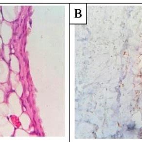 Cea immunoreactivity is also an excellent adenomatoid tumors of the uterus: (PDF) Benign Cystic Mesothelioma in a Girl