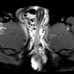 Select from premium fournier gangrene of the highest quality. (PDF) MRI findings in Fournier's gangrene