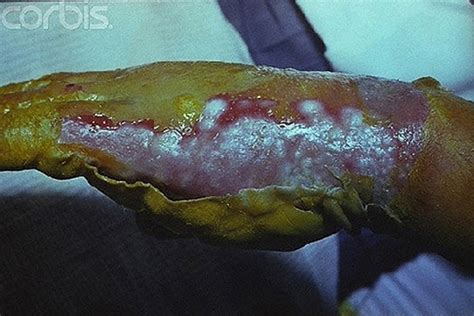 Maybe you would like to learn more about one of these? 피부가 껍질처럼...방사능 피폭 사진 공개 `충격' - 뉴스웨이