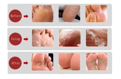 There is lactic acid in milk and it exfoliates dead and dry skin. Get Soft Feet with This Efficient Method - AllDayChic