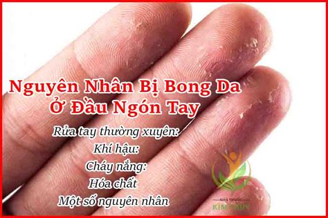 Thethao247 đồng hành cùng bạn đọc. Vì sao bị bong da ở đầu ngón tay? 4+ Cách chữa bệnh ...