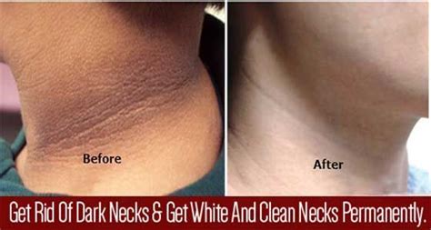 Here's a common type of neck rash you may see on your baby. How to get rid of Dark Neck and underarms at home in just ...