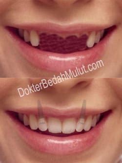 Semua jenis gigi palsu untuk kebutuhan anda, bisa ditemukan di puri dental. biaya implan gigi, harga implan gigi, berapa | dokter ...