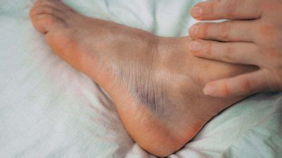 They will do an examination and order fractures can be minor and take a short time to heal or more serious and require extensive surgery and healing times. How Long Does A Sprained Ankle Take To Heal? - Elite Feet