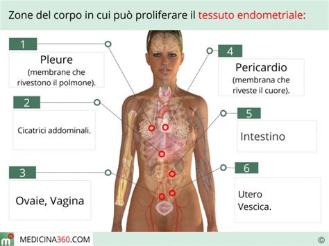 Most often this is on the ovaries, fallopian tubes, and tissue around the uterus and ovaries; Endometriosi: cos'è? Sintomi, diagnosi cura ed alimentazione