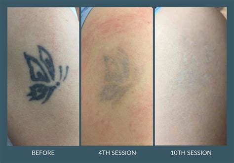 $50 as you increase the level of surface area, with the largest tattoos taking up to $500 per session to remove. Laser Tattoo Removal in Leicester - G-Lasers