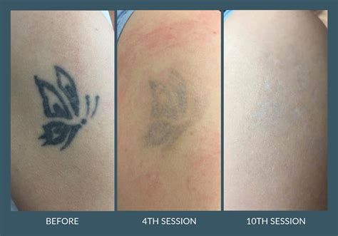 The facility is clean and inviting. Laser Tattoo Removal in Leicester - G-Lasers