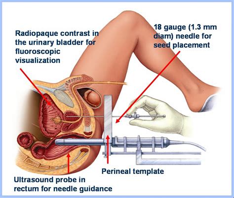 The bobby pins actually make it easy to tug on if i want a little extra. Prostate Massage Technique With Diagram