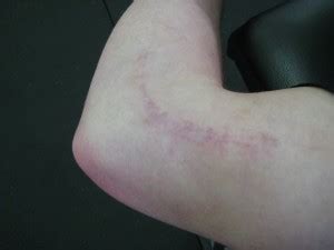 Javelin throwers and football, racquet sports, ice. Pathology & Surgery - Ulnar Collateral Ligament Sprain