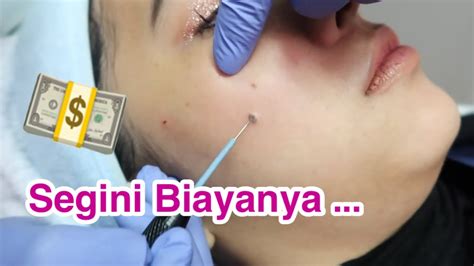 Jika ada tahi lalat menonjol yang ingin dihilangkan, normalnya kita akan disarankan untuk mengunjungi ahli dermatologi atau dokter kulit. Proses Hilangkan Tahi Lalat Hidup - YouTube