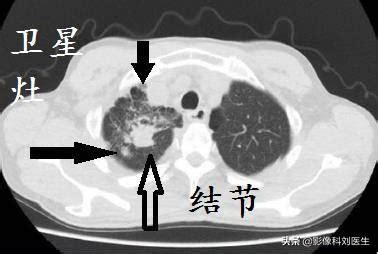 The site owner hides the web page description. 肺結核or肺癌？放射科醫生教你如何用CT鑑別，簡單易懂 - 每日頭條