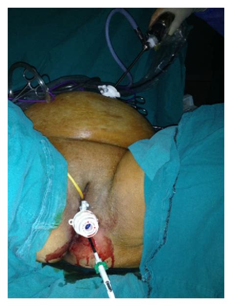 Childhood obesity is becoming an epidemic in america. Transvaginal Appendectomy in Morbidly Obese Patient