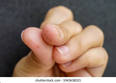 .stick your fingers into a flame and they come out with blisters revealing their selected card! Eczema Inside Anus Dyshidrotic Peeling Skin - kind ...