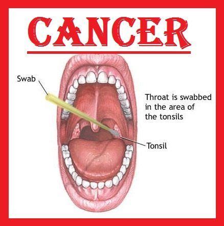 The signs and symptoms of throat cancer depend on the region of the throat that is affected with malignant tumor growth. Throat Cancer | Introduction, Types, Symptoms & Treatment