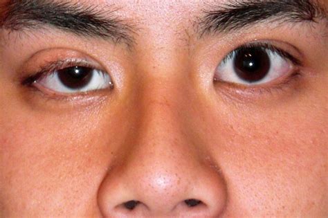 Myasthaenia gravis (mg) is an autoimmune neuromuscular disorder which is twice as common among women, often presenting in the second and third decades of life. Pictures: Guide to Myasthenia Gravis