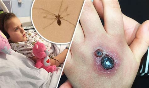 How to identify which spider bit you. Little girl hospitalised with hole in her hand after being ...