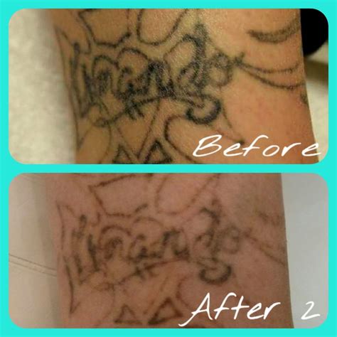 Vanishing point has been providing the st louis community and surrounding areas with a safe, effective, and affordable tattoo removal service since 2008. Oops! Laser Tattoo Removal - Tattoo Removal - 5655 E Grant ...