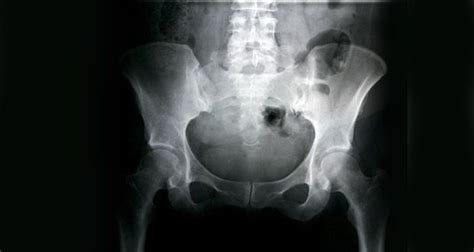 Avascular necrosis (AVN), also called osteonecrosis ...