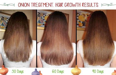 Yes, onion juice plays an important role in promoting hair growth and preventing hair fall. Onion juice hair growth before and after | Hair regrowth ...