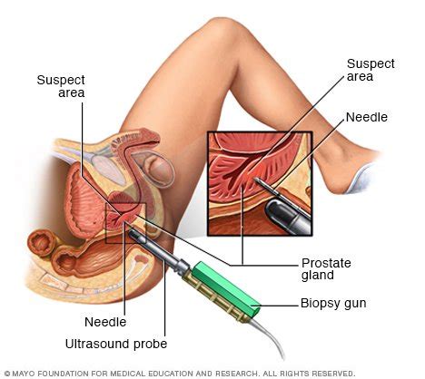 They should perhaps have said t1n0m0. Prostate cancer Disease Reference Guide - Drugs.com