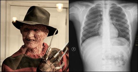 Based on a true story. The Real Condition Behind 'A Nightmare On Elm Street'