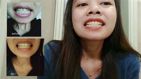 Closing a gap between two teeth without considering the rest of the teeth can throw the rest of the jaw's alignment off, or cause major problems somewhere else in the mouth. MERAPIHKAN GIGI RENGGANG TANPA BEHEL || close teeth gap ...