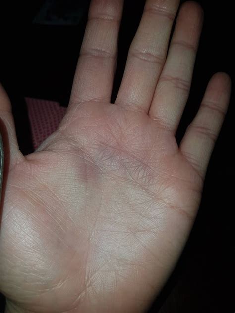 When im cold, my hands go really pale and sometimes blue. Purple spot on palm of hand. Similar but smaller spot on ...