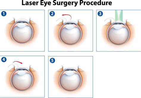 .transparent laser eyes png images for. Download Transparent Laser Eye Surgery Procedure - PNGkit